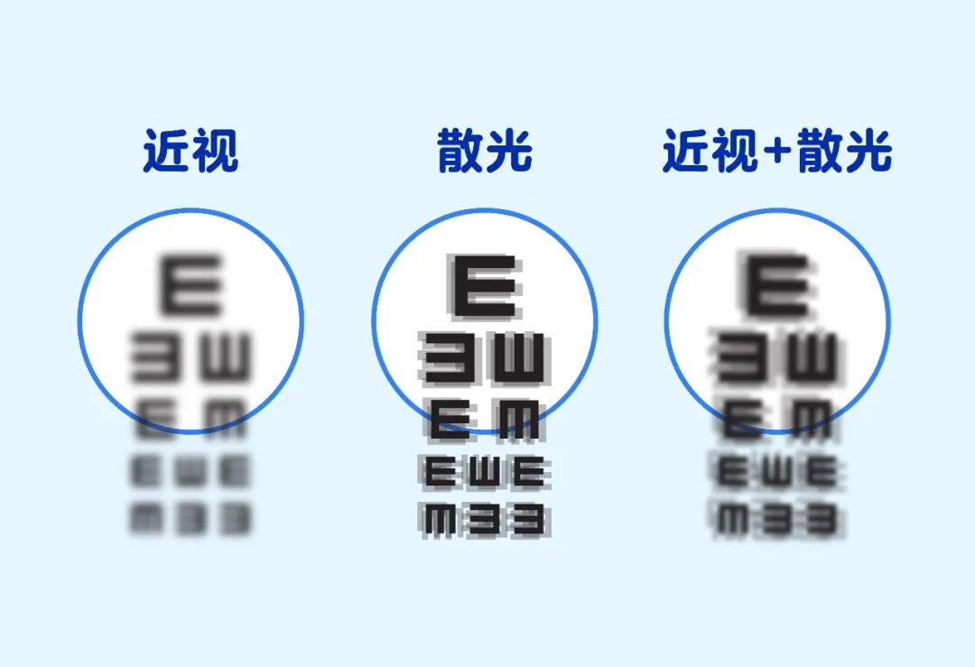 近视手术的“赠品”：散光居然能“买一送一”被消除？