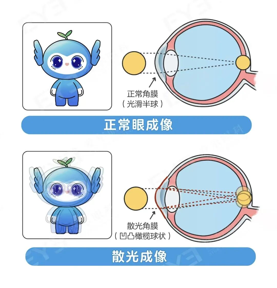 近视手术的“赠品”：散光居然能“买一送一”被消除？