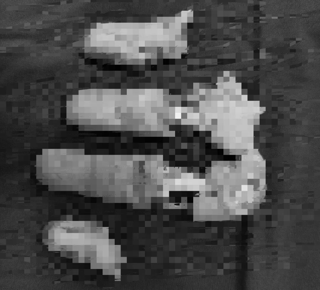 指尖 “毫米级绣花”！一次性完成 4 根重度毁损断指再植，技术拉满……