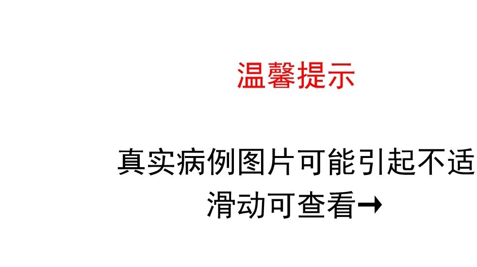 江北新区首例心包补片重建 AVG 手术在南京江北医院成功实施！76 岁重度二尖瓣环钙化心衰患者顺利康复出院