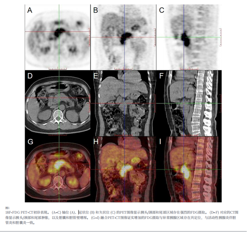 河北一洲肿瘤医院康静波教授团队在国际权威SCI期刊《Frontiers in Medicine》发表重要病例报告
