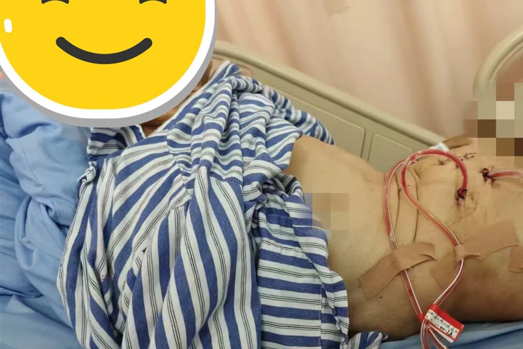 腰弯成虾，胃挤进死角 | 这台手术，医生在「夹缝中切癌」