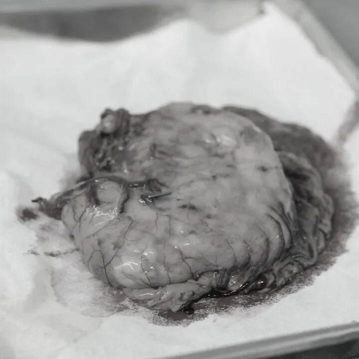 腰弯成虾，胃挤进死角 | 这台手术，医生在「夹缝中切癌」