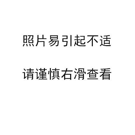 腰弯成虾，胃挤进死角 | 这台手术，医生在「夹缝中切癌」
