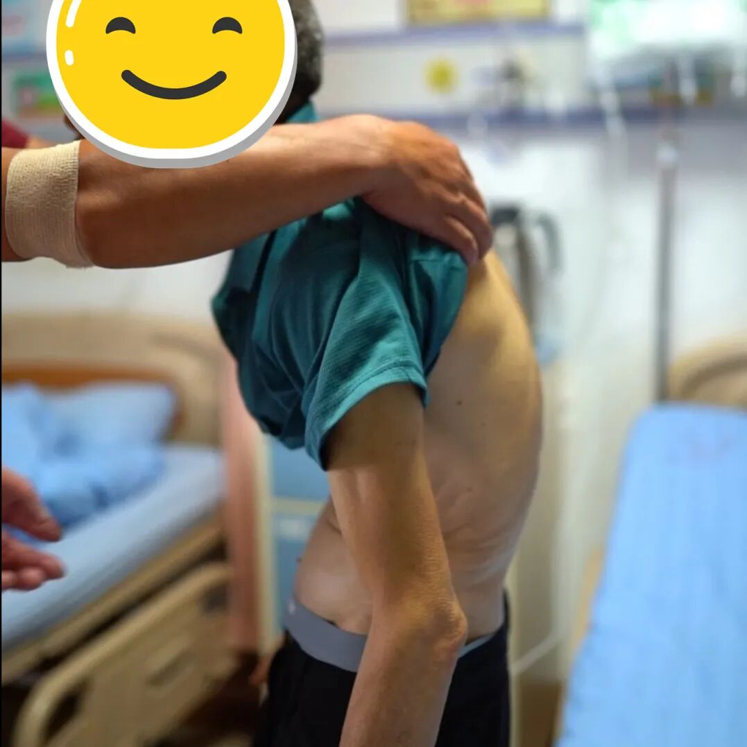 腰弯成虾，胃挤进死角 | 这台手术，医生在「夹缝中切癌」