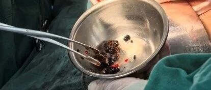 高龄多次胆道术后复发结石 胆石病诊疗中心精细手术化解诊疗难题