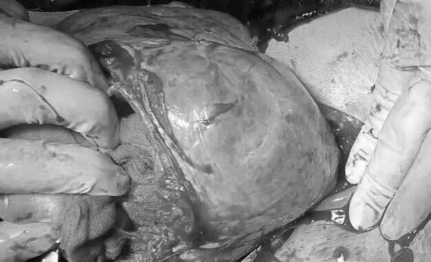 连续三例高危孕产妇救治成功!淮安市一院产科MDT团队尽显硬核实力