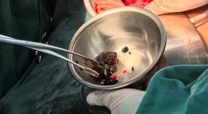 高龄多次胆道术后复发结石 胆石病诊疗中心精细手术化解诊疗难题