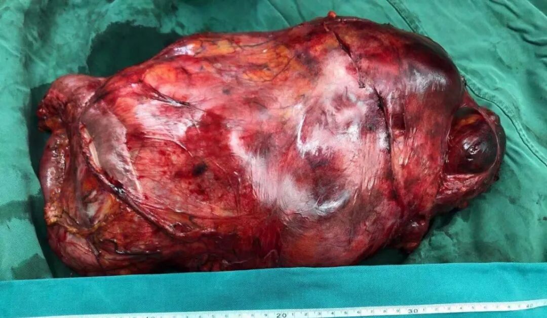 专科实力聚焦:我院腹膜后肿瘤诊疗中心完成巨大腹膜后肿瘤多脏器联合切除术