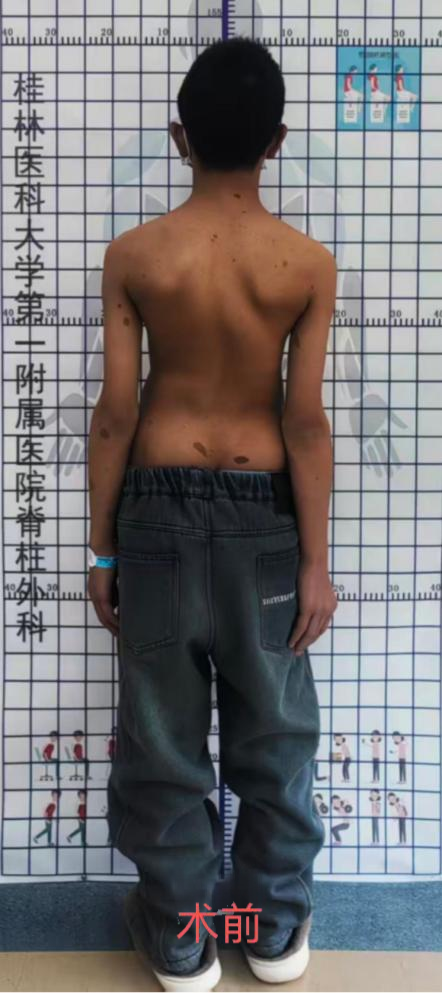 罕见病致脊柱弯至90度！桂医大一附院脊柱外科成功治疗13岁极重度侧弯少年