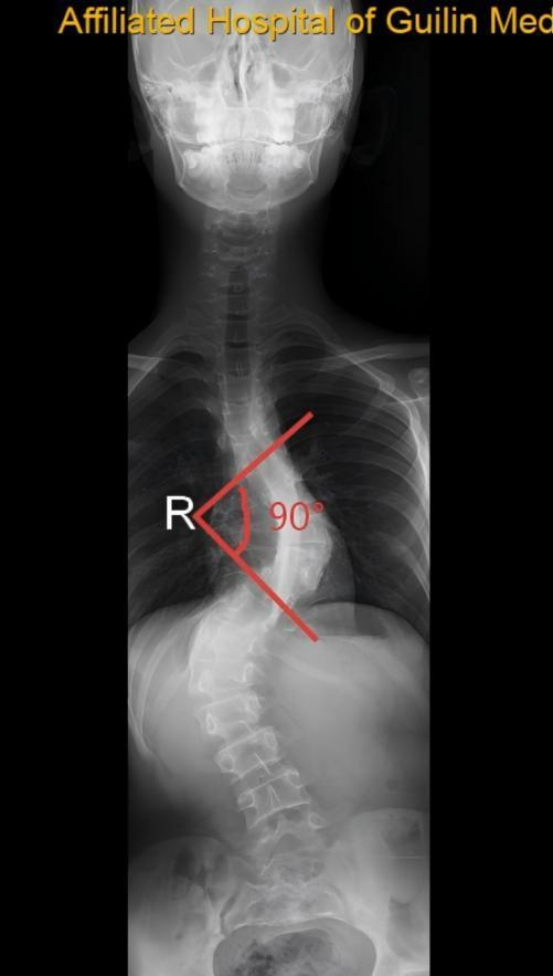 罕见病致脊柱弯至90度！桂医大一附院脊柱外科成功治疗13岁极重度侧弯少年