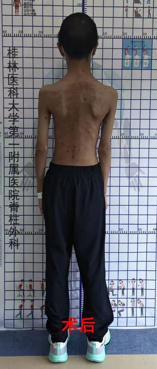 罕见病致脊柱弯至90度！桂医大一附院脊柱外科成功治疗13岁极重度侧弯少年