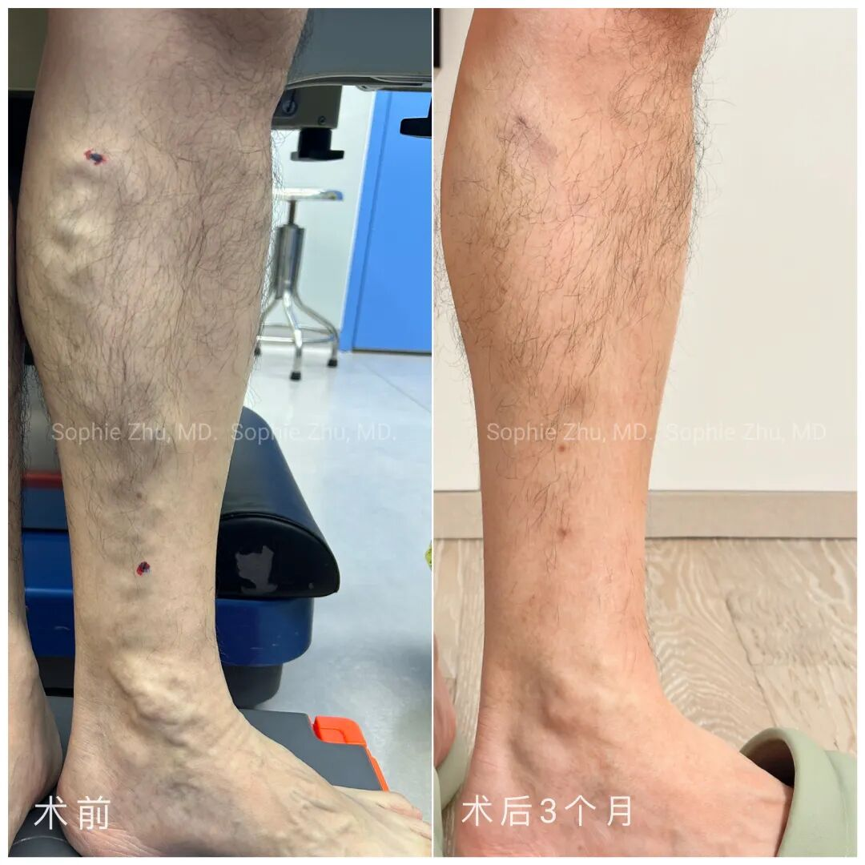 静脉曲张到底能不能多走路？很多人第一步就做错了！