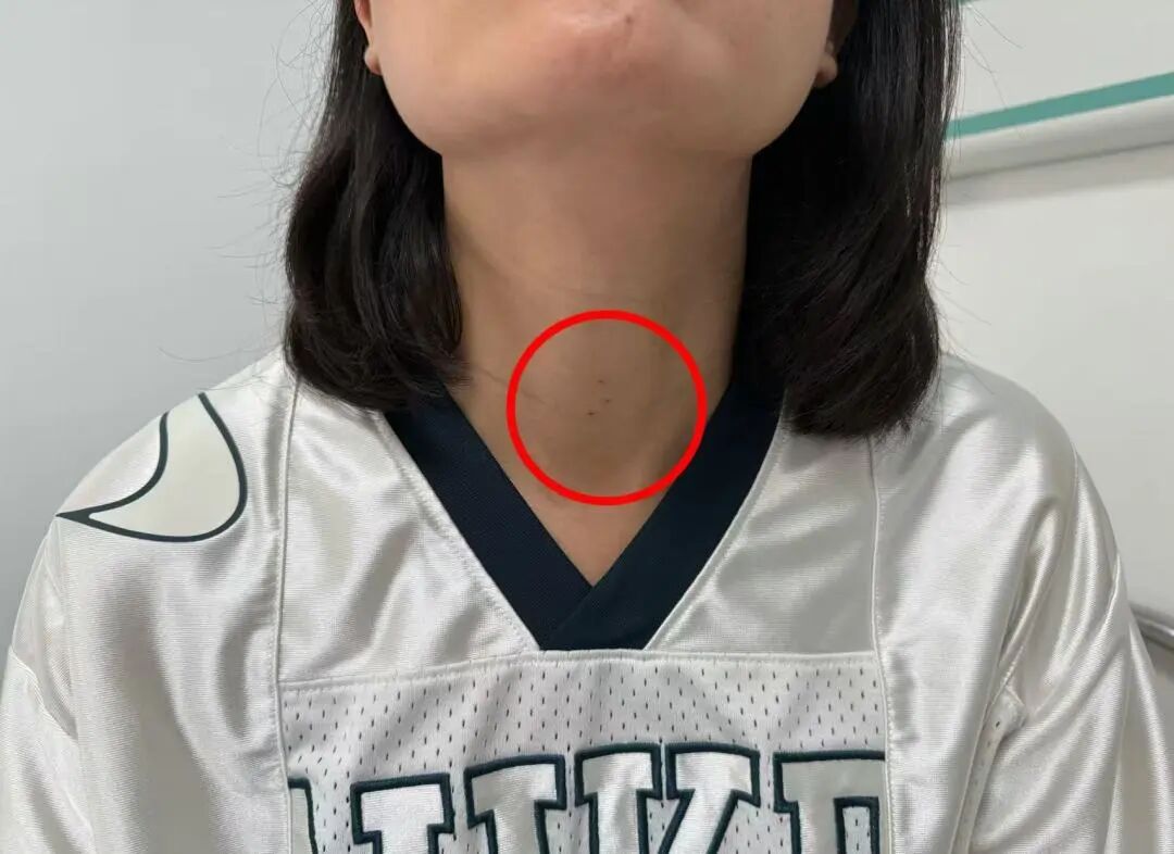 【守护健康】告别开刀留疤！甲状腺微波消融，温柔治愈结节困扰