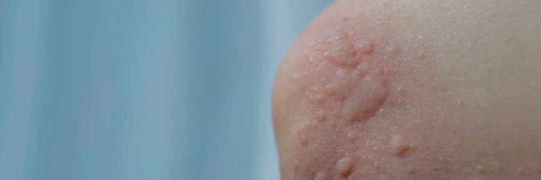 近期高发!这种"蚊子包",真的别挠!