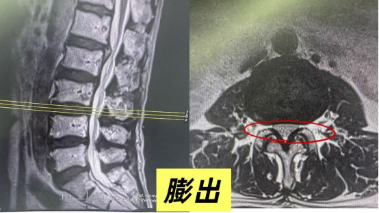 腰椎影像报告:膨出、突出、脱出,一字之差,病情完全不同