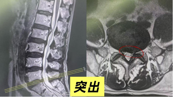 腰椎影像报告:膨出、突出、脱出,一字之差,病情完全不同