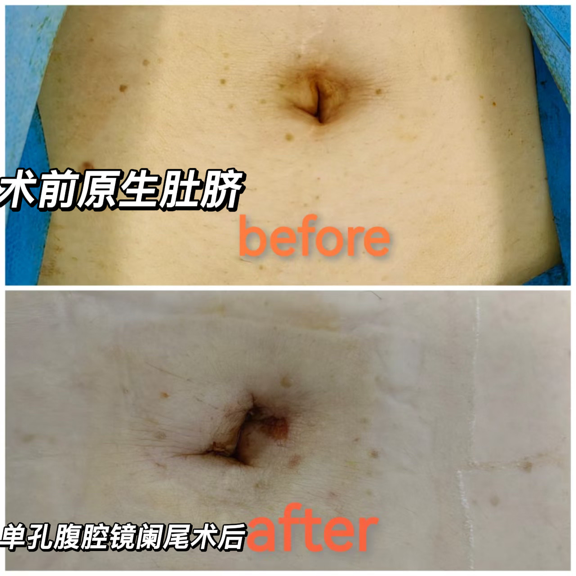 阑尾手术还怕留疤？这个技术让疤痕“躲”进肚脐眼