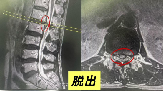 腰椎影像报告:膨出、突出、脱出,一字之差,病情完全不同