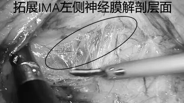 毫米精微解剖,守护盆腔神经功能|FTME功能性直肠根治术斩获淮安市一院2026年重大实用领先技术二等奖