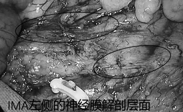 毫米精微解剖,守护盆腔神经功能|FTME功能性直肠根治术斩获淮安市一院2026年重大实用领先技术二等奖