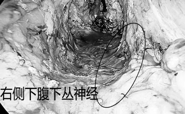 毫米精微解剖,守护盆腔神经功能|FTME功能性直肠根治术斩获淮安市一院2026年重大实用领先技术二等奖