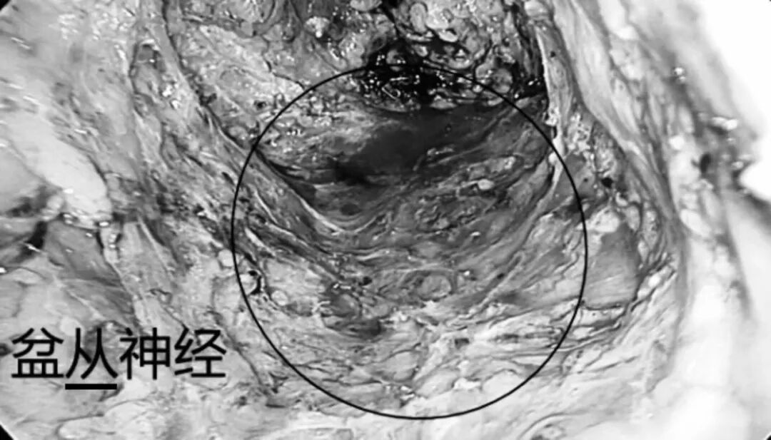 毫米精微解剖,守护盆腔神经功能|FTME功能性直肠根治术斩获淮安市一院2026年重大实用领先技术二等奖