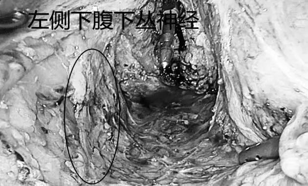 毫米精微解剖,守护盆腔神经功能|FTME功能性直肠根治术斩获淮安市一院2026年重大实用领先技术二等奖