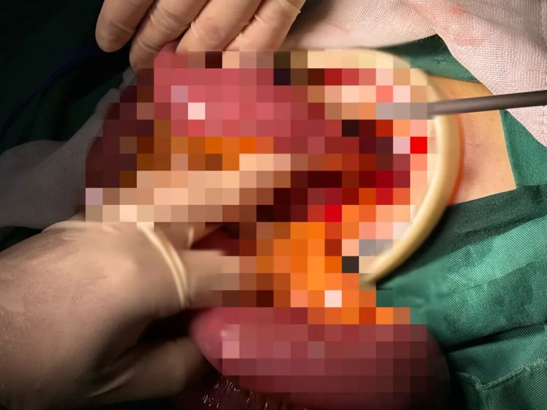 高龄喉癌患者突发急腹症，多学科联动成功救治
