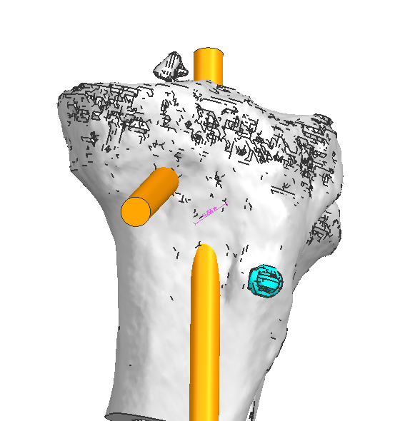 【优质服务】数百公里求医路,关节·运动医学科用3D打印技术交出“满意答卷”