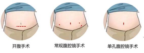 肠癌手术选单孔，创伤更小、康复更轻松！常州二院这项微创技术守护消化道健康