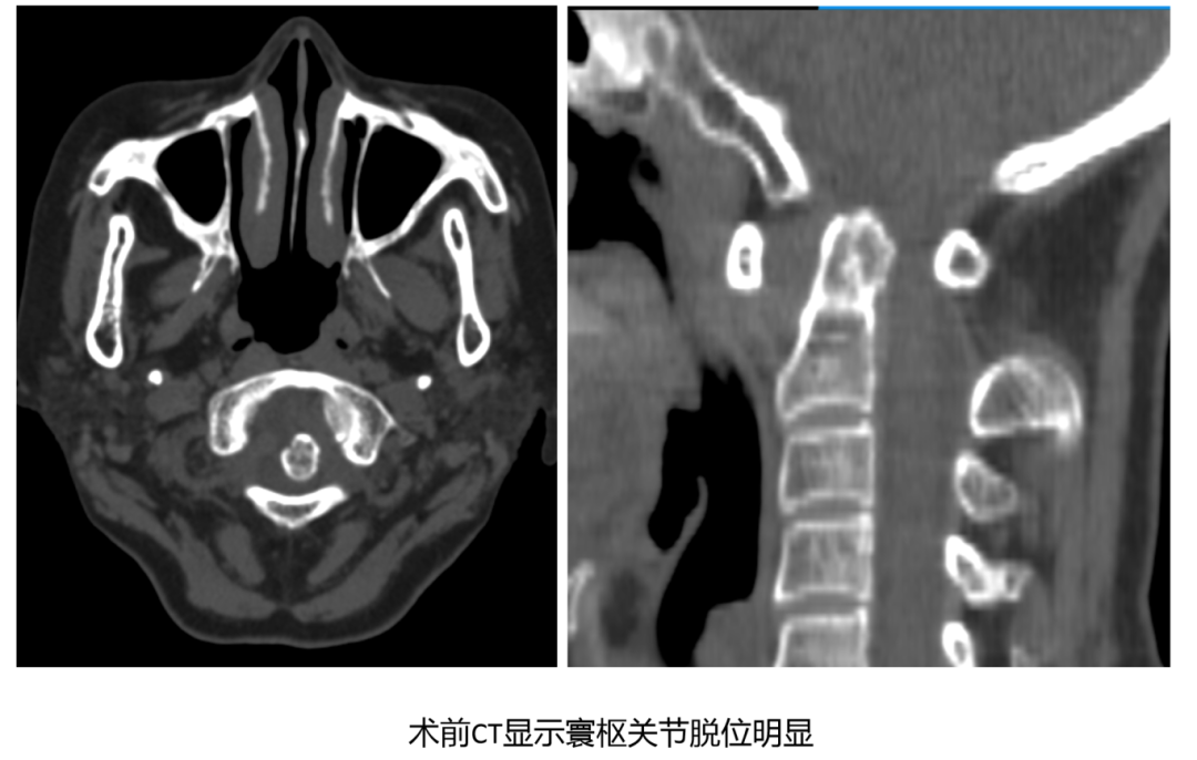 技术突破｜勇闯“手术禁区”！我院脊柱外科成功完成首例复杂上颈椎融合手术——标志着我院在脊柱外科高精尖技术领域迈上新台阶
