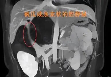 精准“拆弹” | 无明显不适，19岁少女体内却藏着19厘米巨型肿瘤，还包绕重要血管！