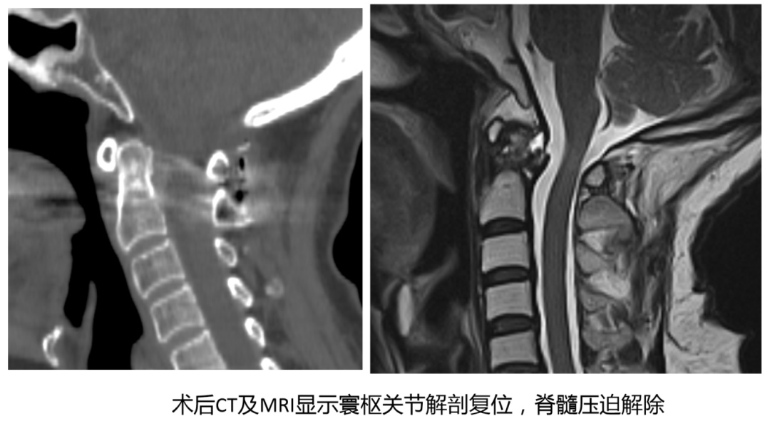 技术突破｜勇闯“手术禁区”！我院脊柱外科成功完成首例复杂上颈椎融合手术——标志着我院在脊柱外科高精尖技术领域迈上新台阶
