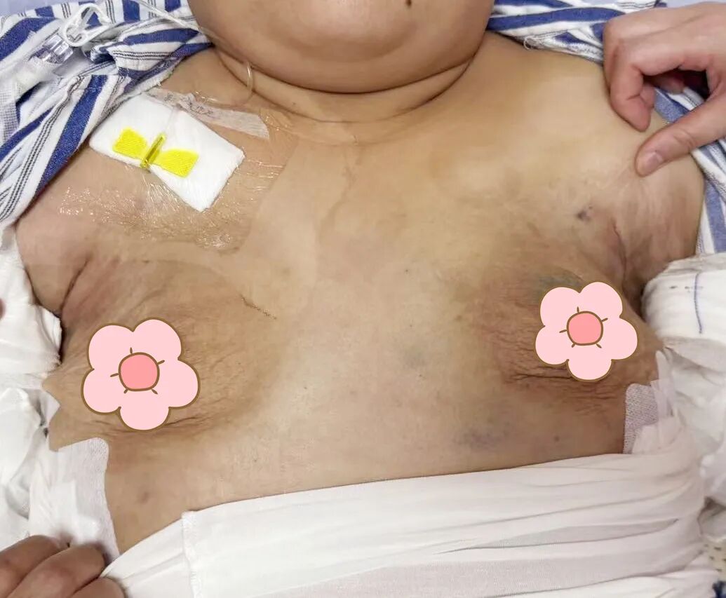 漳州前列,百例无痕 | 吴秀萍的乳腺腔镜“美学”