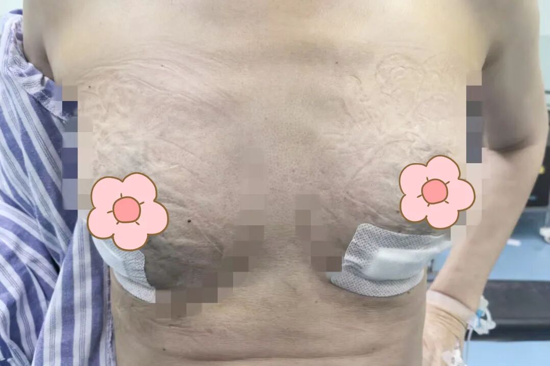 漳州前列,百例无痕 | 吴秀萍的乳腺腔镜“美学”
