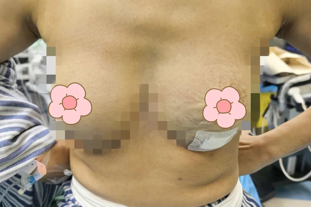 漳州前列,百例无痕 | 吴秀萍的乳腺腔镜“美学”