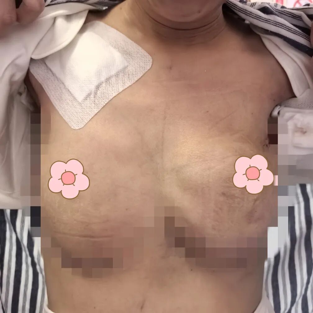 漳州前列,百例无痕 | 吴秀萍的乳腺腔镜“美学”