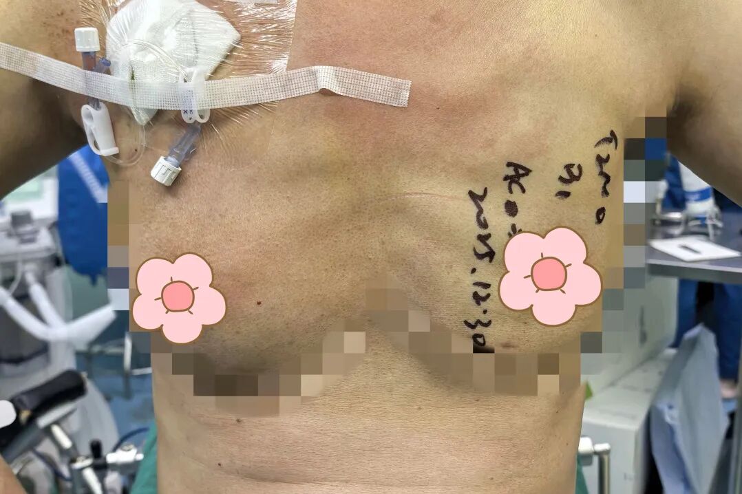 漳州前列,百例无痕 | 吴秀萍的乳腺腔镜“美学”