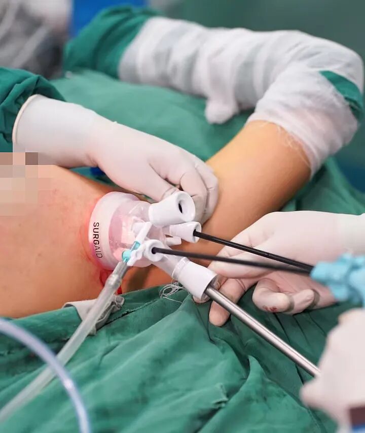 漳州前列，百例无痕 | 吴秀萍的乳腺腔镜“美学”