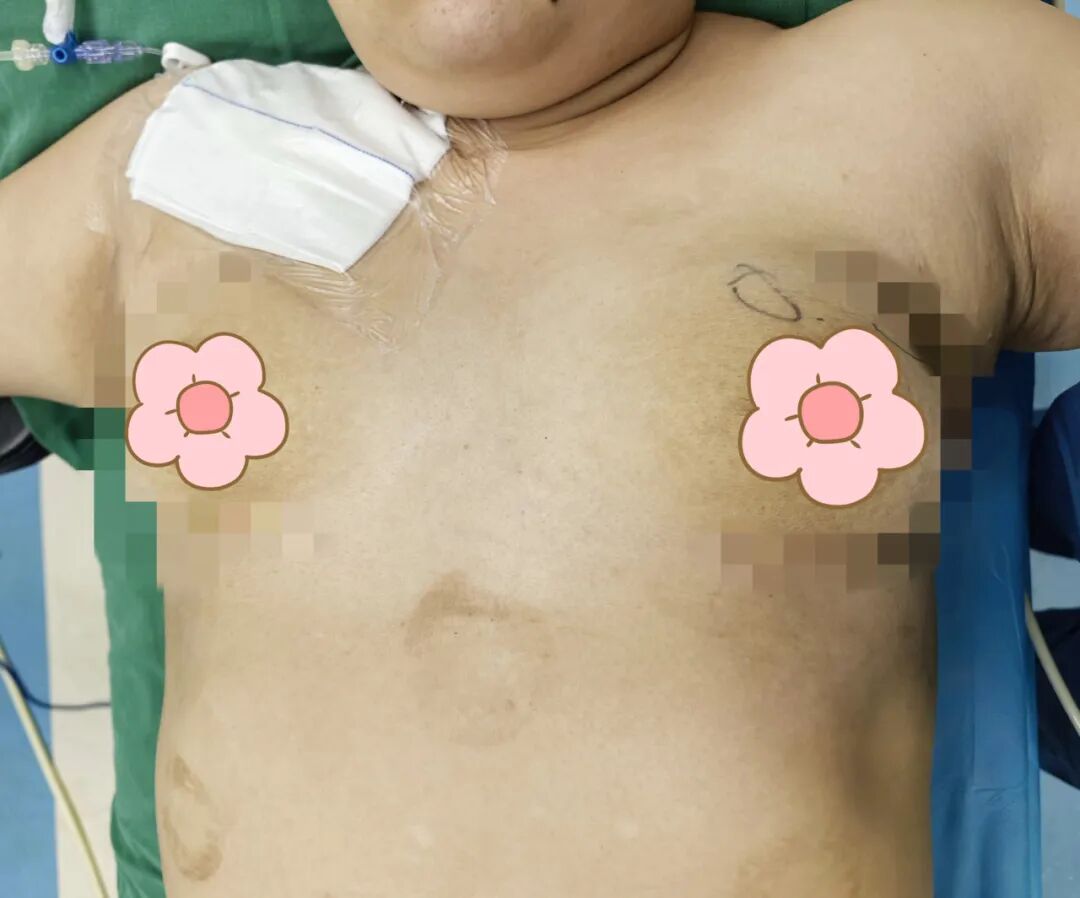 漳州前列,百例无痕 | 吴秀萍的乳腺腔镜“美学”