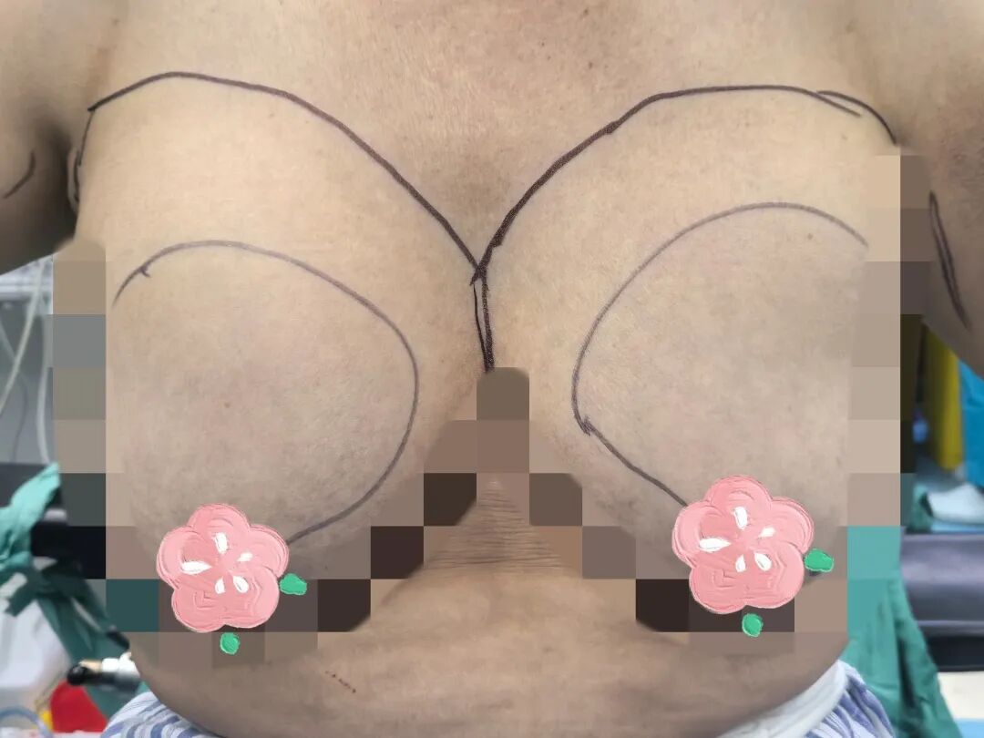 漳州前列,百例无痕 | 吴秀萍的乳腺腔镜“美学”