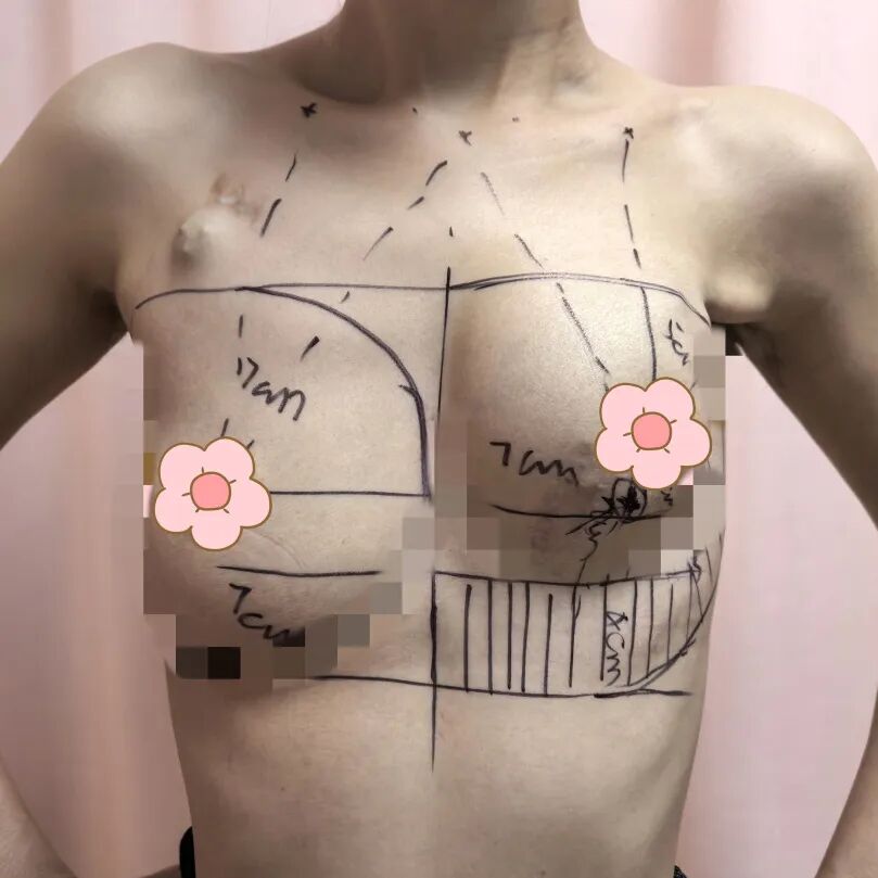 漳州前列,百例无痕 | 吴秀萍的乳腺腔镜“美学”