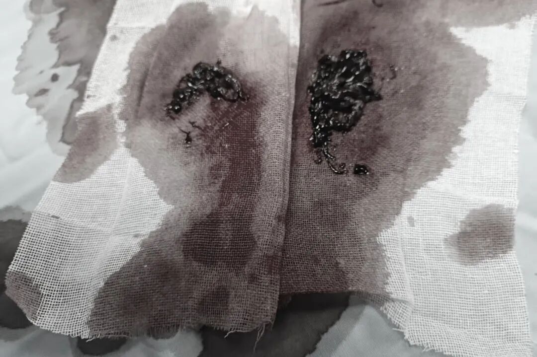 取出致命血栓，重启顺畅呼吸｜一附院呼吸团队介入取栓挽救肺动脉栓塞危重患者