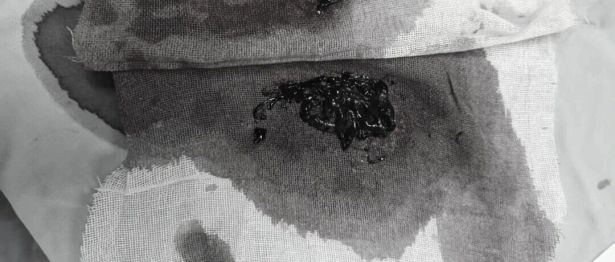 取出致命血栓，重启顺畅呼吸｜一附院呼吸团队介入取栓挽救肺动脉栓塞危重患者