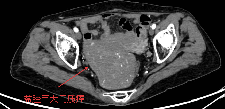 腿痛查出大问题！73岁奶奶患罕见双肿瘤，荆门市中心医院MDT团队一次攻克！