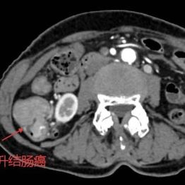 腿痛查出大问题！73岁奶奶患罕见双肿瘤，荆门市中心医院MDT团队一次攻克！