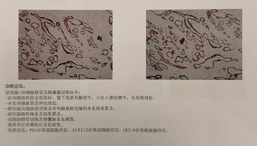 赴莞寻良医!台心医院周兴教授团队实施 3D 腹腔镜手术,为三亚患者成功根治前列腺癌