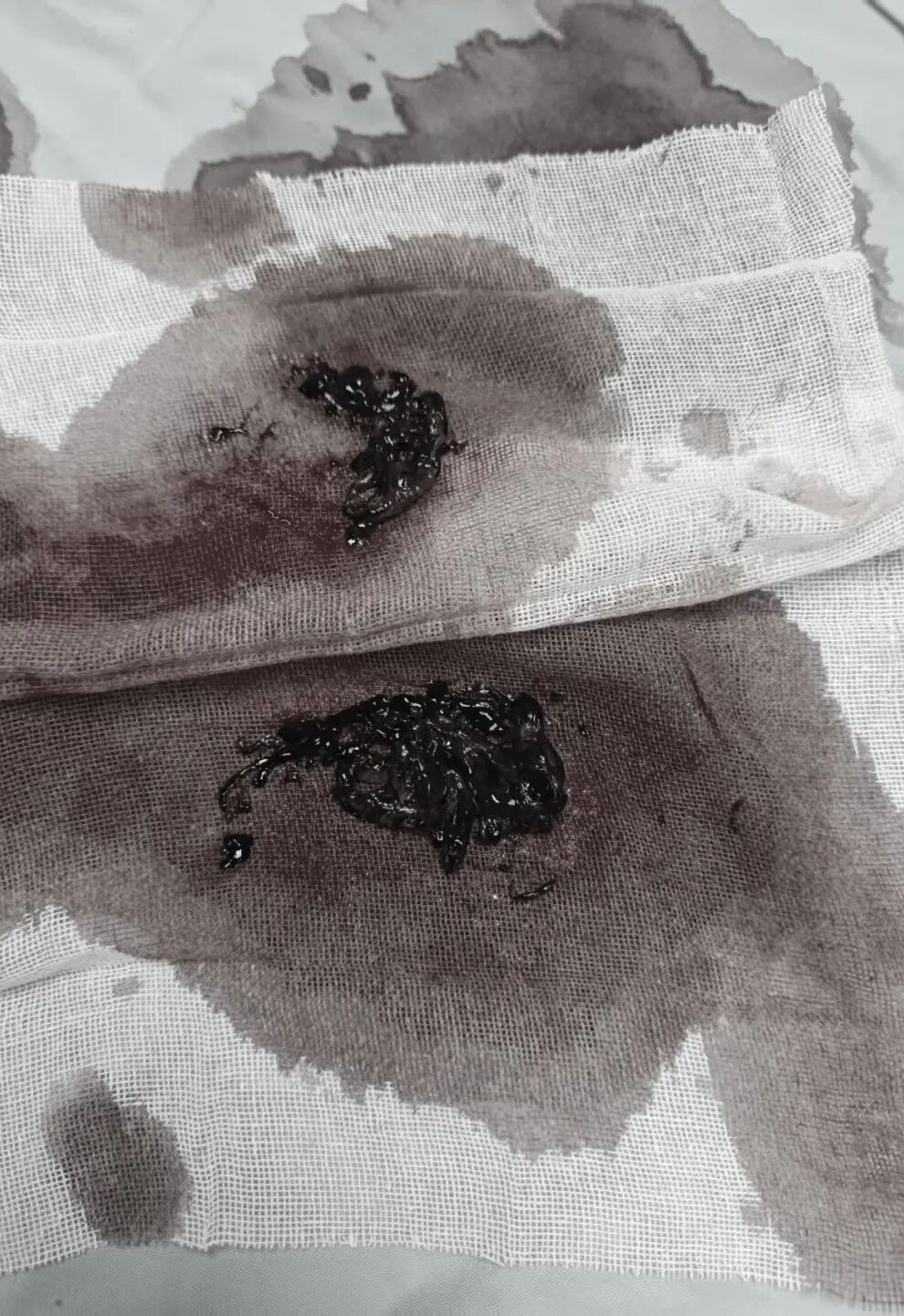 取出致命血栓，重启顺畅呼吸｜一附院呼吸团队介入取栓挽救肺动脉栓塞危重患者