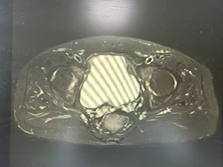 赴莞寻良医!台心医院周兴教授团队实施 3D 腹腔镜手术,为三亚患者成功根治前列腺癌
